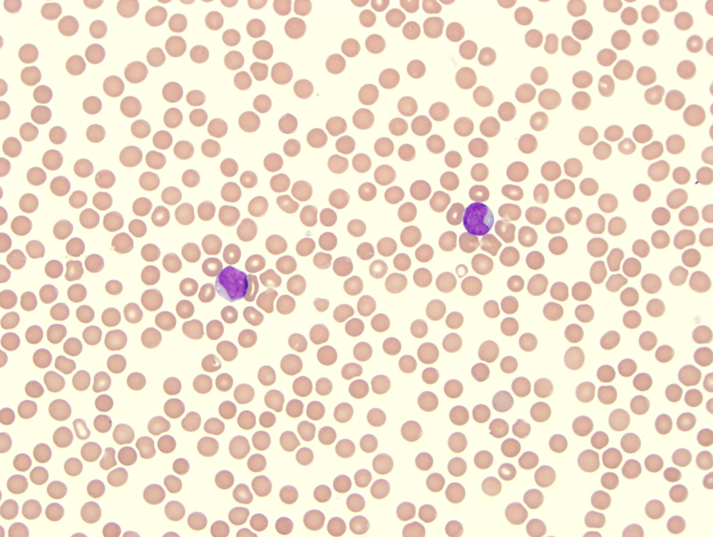 peripheral blood 2012: circulating blasts-1